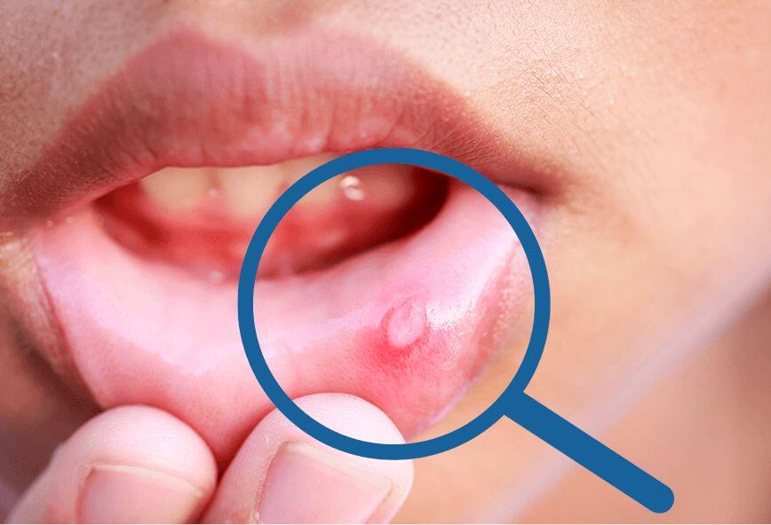 Indicado en aftas, heridas o úlceras en la boca.