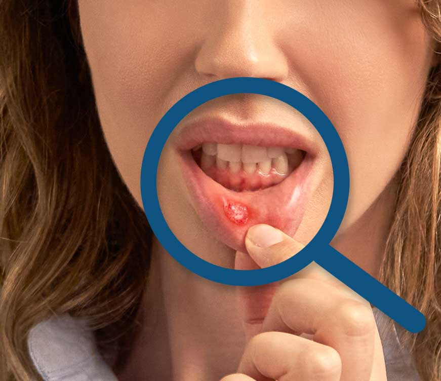 Las aftas, conocidas comúnmente como llagas de la boca, son pequeñas lesiones, heridas o úlceras que aparecen sobre la mucosa de la boca y la lengua y también en las encías.
